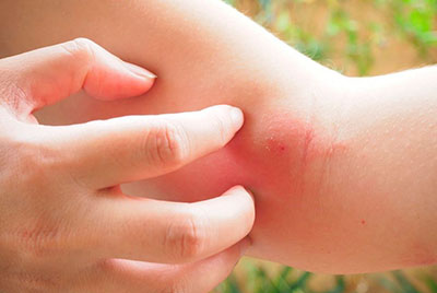 Аллергия на укусы насекомых: все, что нужно знать, чтобы избежать последствий