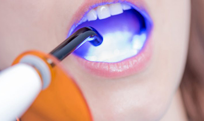 Пломбирование зубов — виды материалов, установки 