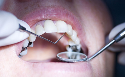 Альтернатива амальгамным материалам в стоматологии