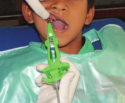 Особенности местной анестезии в детской стоматологии