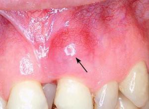 Осторожно — киста корня зуба — капсульная инфекция