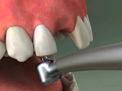 Учитываемые особенности боковых резцов и клыков верхней челюсти при протезировании зубов