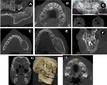 Компьютерная и обычная томография в стоматологии