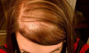 Диффузное выпадение волос у женщин. Причины и методы устранения болезни