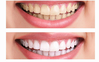 Отбеливание зубов – плюсы и минусы