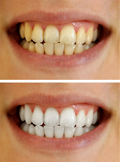 Различные методы отбеливания зубов - сравнение и недостатки